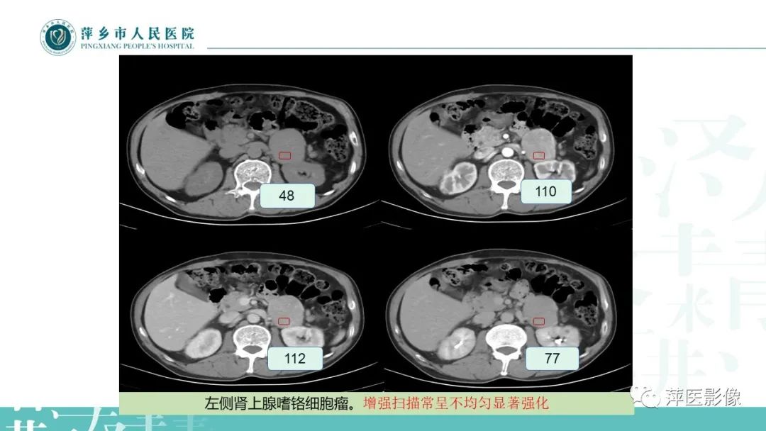 影像PPT - 【PPT】肾上腺嗜铬细胞瘤及肾上腺占位性病变-18