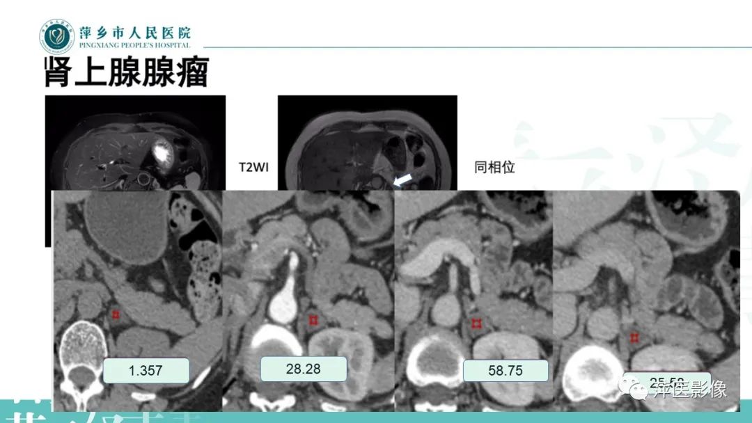 影像PPT - 【PPT】肾上腺嗜铬细胞瘤及肾上腺占位性病变-25
