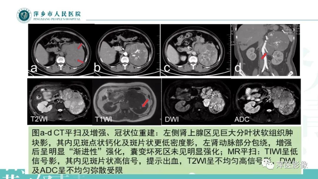 影像PPT - 【PPT】肾上腺嗜铬细胞瘤及肾上腺占位性病变-28