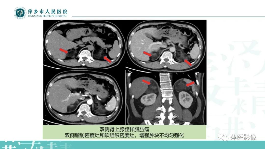影像PPT - 【PPT】肾上腺嗜铬细胞瘤及肾上腺占位性病变-31