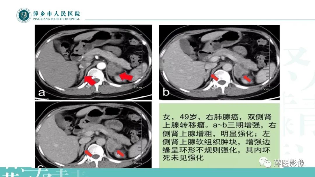 影像PPT - 【PPT】肾上腺嗜铬细胞瘤及肾上腺占位性病变-34