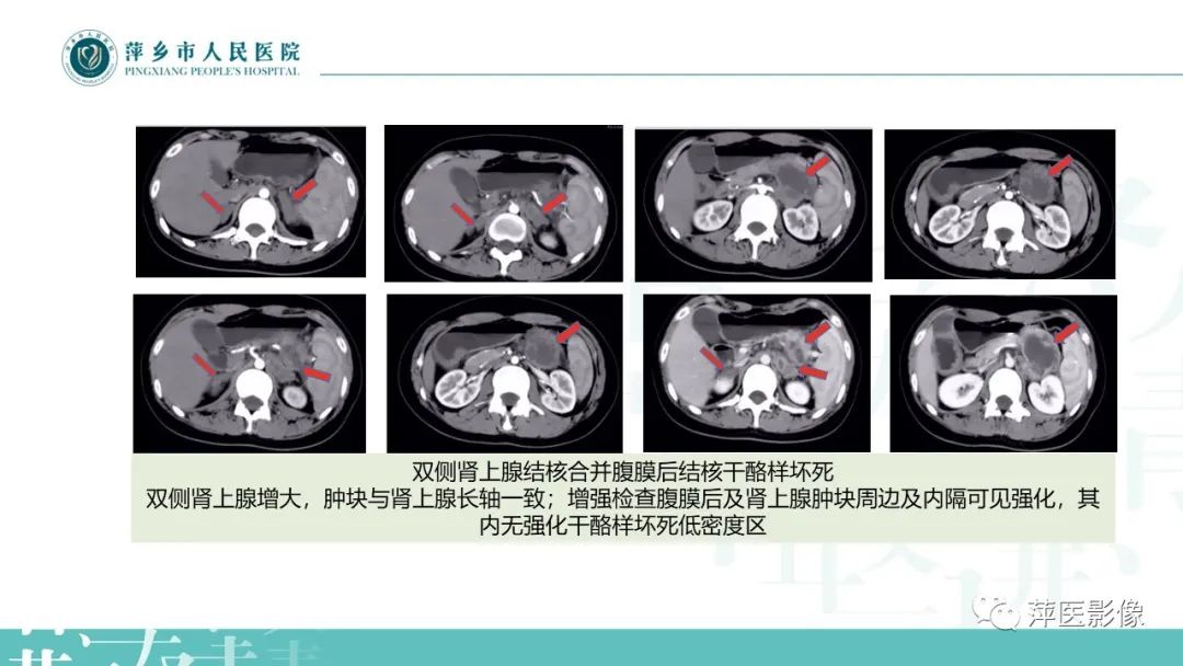 影像PPT - 【PPT】肾上腺嗜铬细胞瘤及肾上腺占位性病变-37