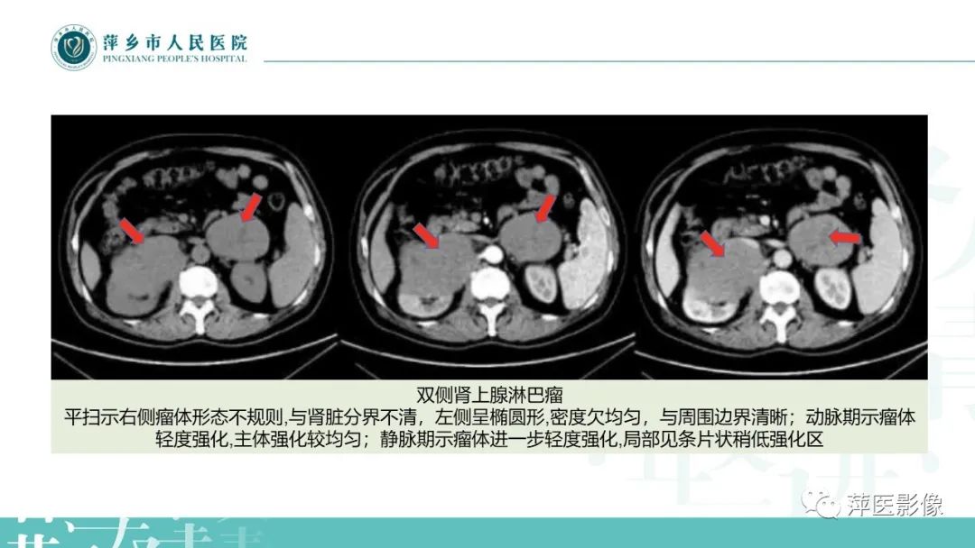 影像PPT - 【PPT】肾上腺嗜铬细胞瘤及肾上腺占位性病变-39