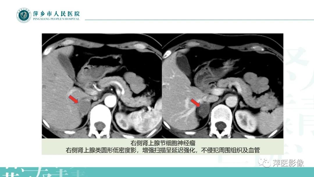 影像PPT - 【PPT】肾上腺嗜铬细胞瘤及肾上腺占位性病变-41