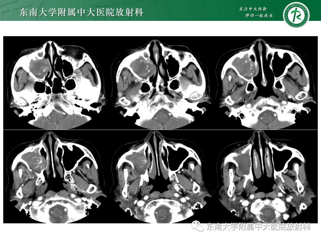影像PPT - 【PPT】以上颌窦为中心的鼻腔鼻窦占位性病变随访-4