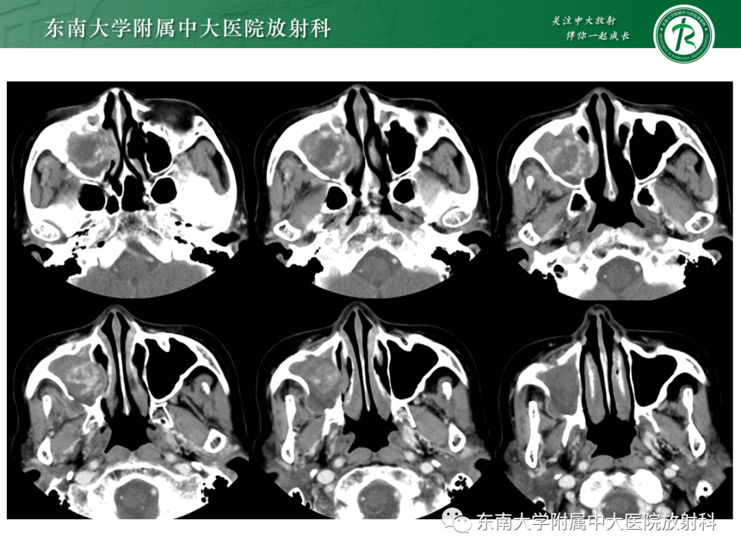 影像PPT - 【PPT】以上颌窦为中心的鼻腔鼻窦占位性病变随访-5