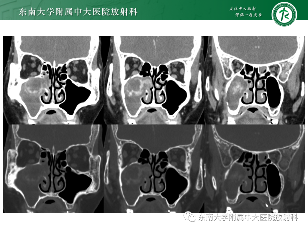 影像PPT - 【PPT】以上颌窦为中心的鼻腔鼻窦占位性病变随访-6