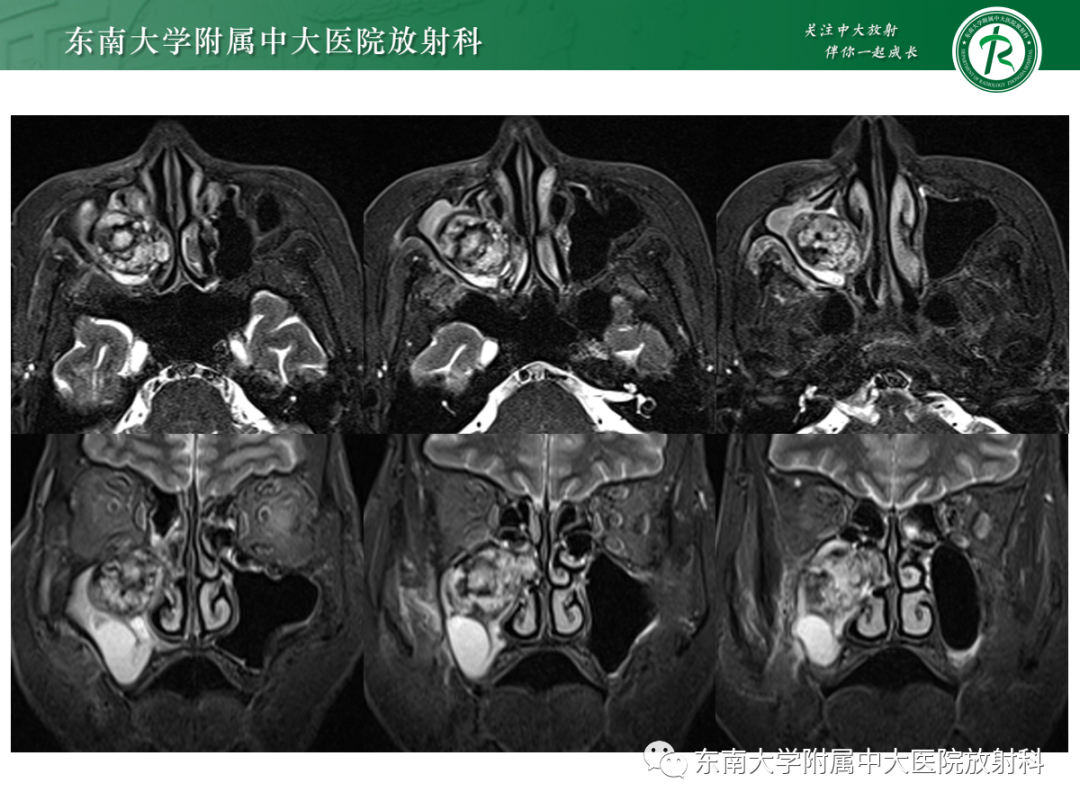 影像PPT - 【PPT】以上颌窦为中心的鼻腔鼻窦占位性病变随访-7