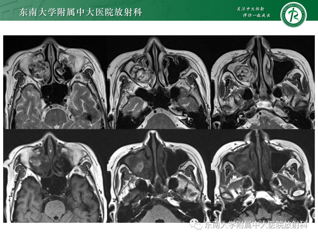 影像PPT - 【PPT】以上颌窦为中心的鼻腔鼻窦占位性病变随访-8