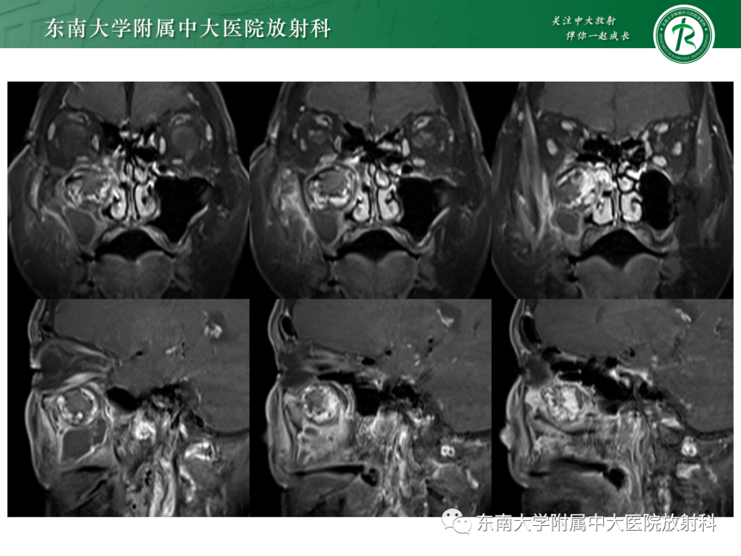影像PPT - 【PPT】以上颌窦为中心的鼻腔鼻窦占位性病变随访-9