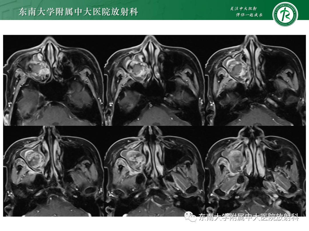 影像PPT - 【PPT】以上颌窦为中心的鼻腔鼻窦占位性病变随访-10