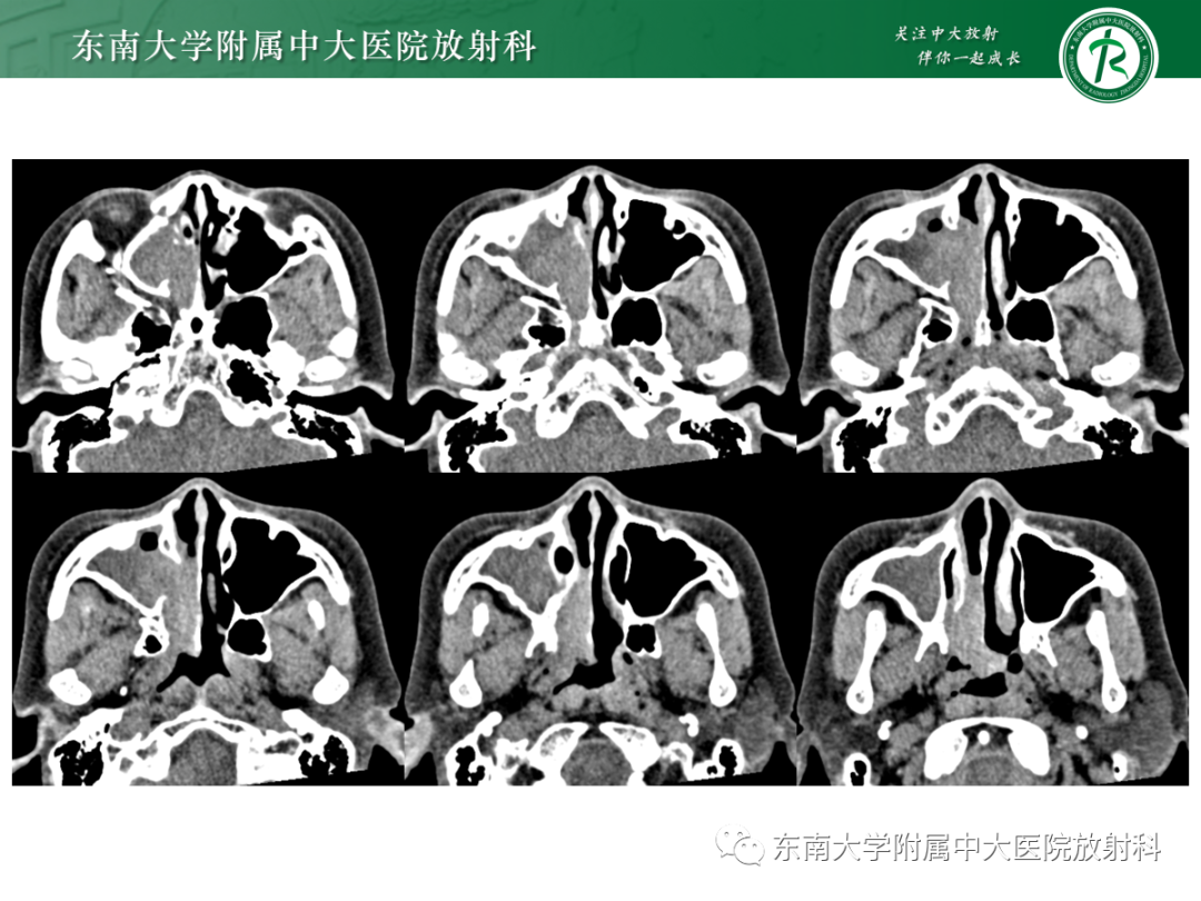 影像PPT - 【PPT】以上颌窦为中心的鼻腔鼻窦占位性病变随访-12