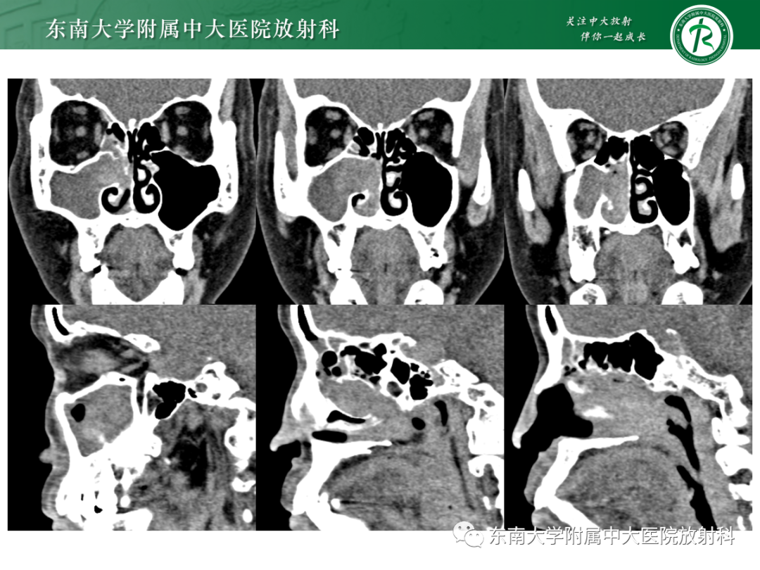 影像PPT - 【PPT】以上颌窦为中心的鼻腔鼻窦占位性病变随访-13