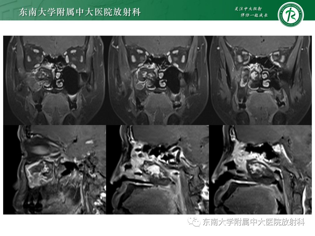 影像PPT - 【PPT】以上颌窦为中心的鼻腔鼻窦占位性病变随访-14