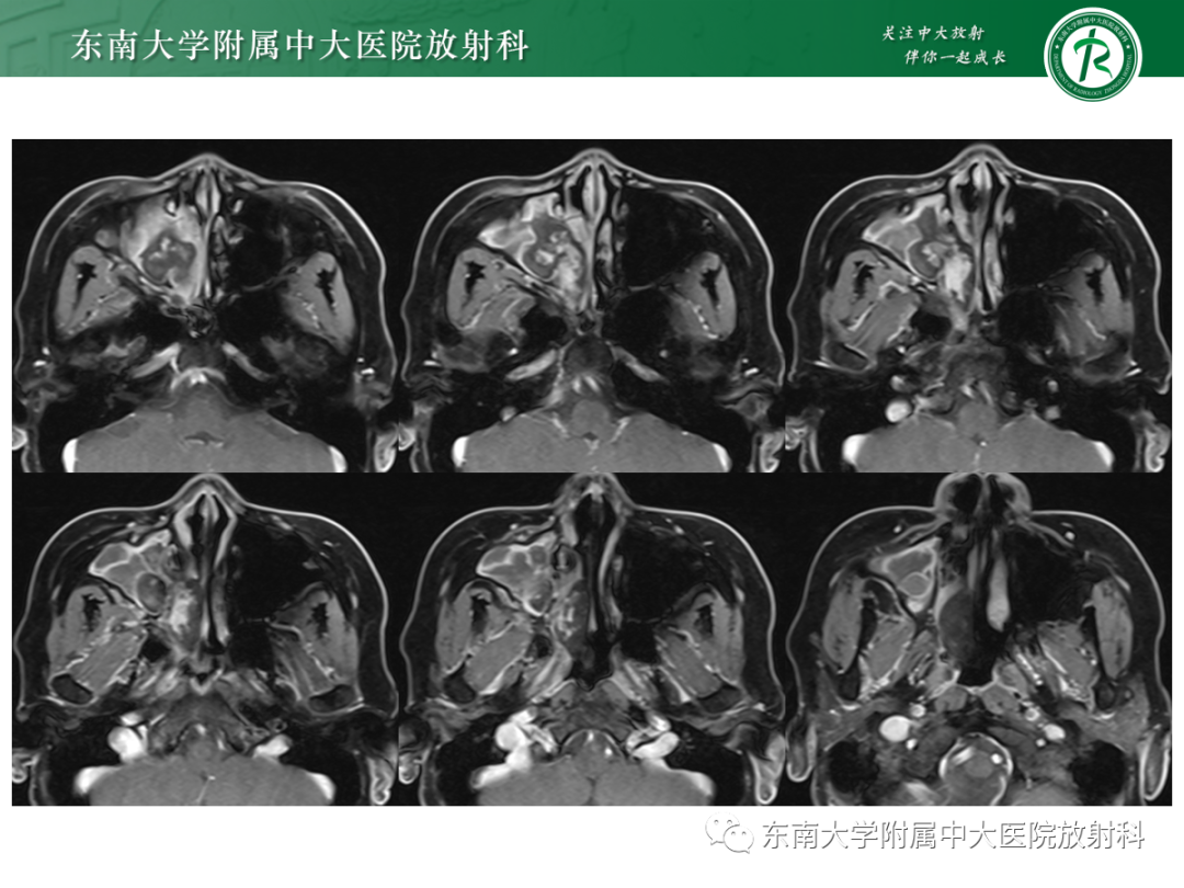 影像PPT - 【PPT】以上颌窦为中心的鼻腔鼻窦占位性病变随访-15