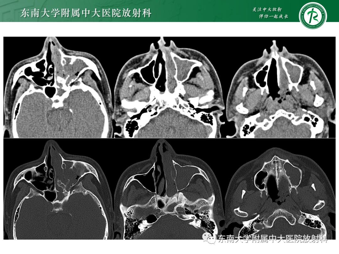 影像PPT - 【PPT】以上颌窦为中心的鼻腔鼻窦占位性病变随访-18