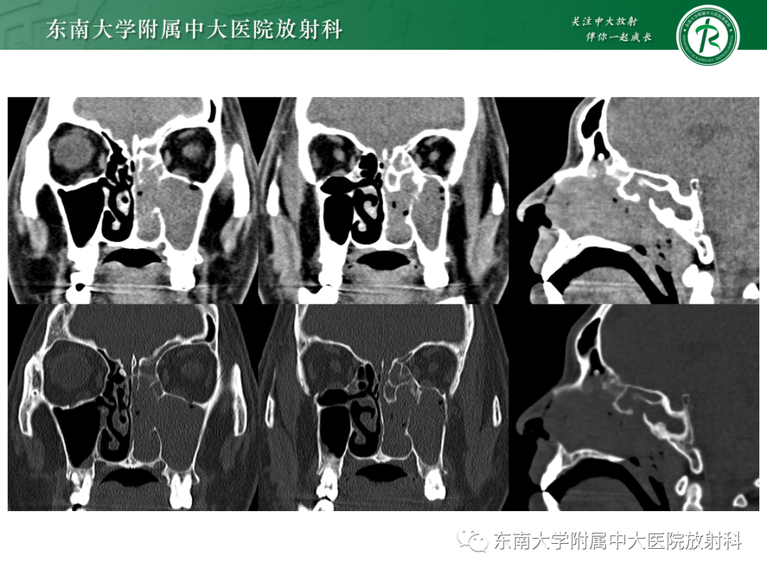 影像PPT - 【PPT】以上颌窦为中心的鼻腔鼻窦占位性病变随访-19