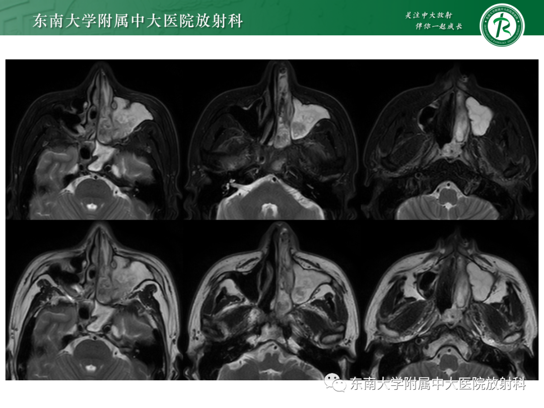 影像PPT - 【PPT】以上颌窦为中心的鼻腔鼻窦占位性病变随访-20