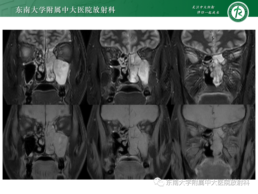影像PPT - 【PPT】以上颌窦为中心的鼻腔鼻窦占位性病变随访-21