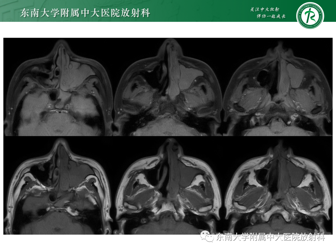 影像PPT - 【PPT】以上颌窦为中心的鼻腔鼻窦占位性病变随访-22