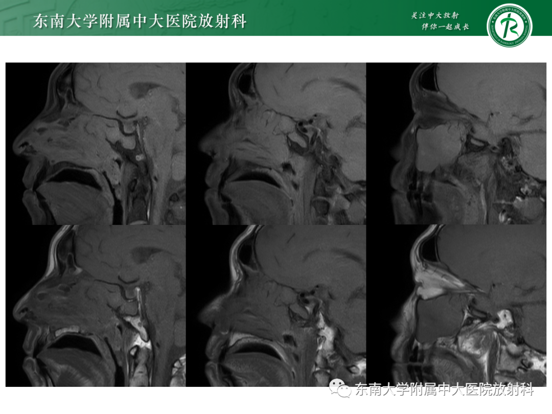 影像PPT - 【PPT】以上颌窦为中心的鼻腔鼻窦占位性病变随访-23