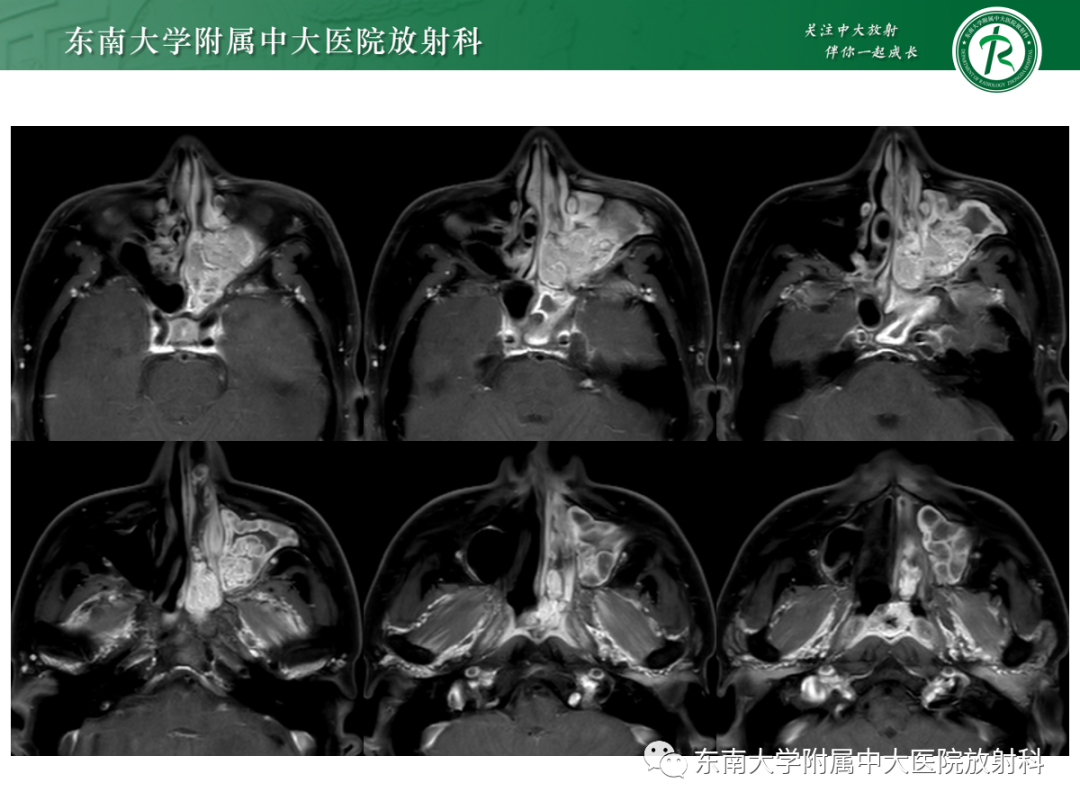 影像PPT - 【PPT】以上颌窦为中心的鼻腔鼻窦占位性病变随访-24