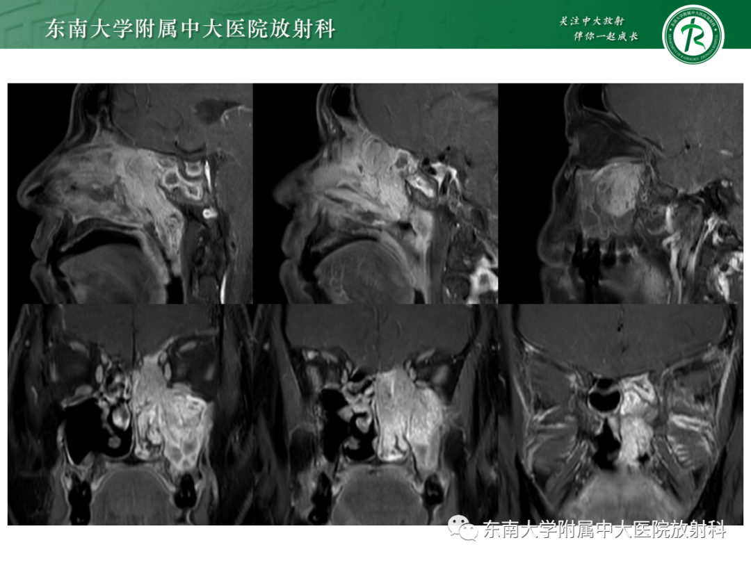 影像PPT - 【PPT】以上颌窦为中心的鼻腔鼻窦占位性病变随访-25