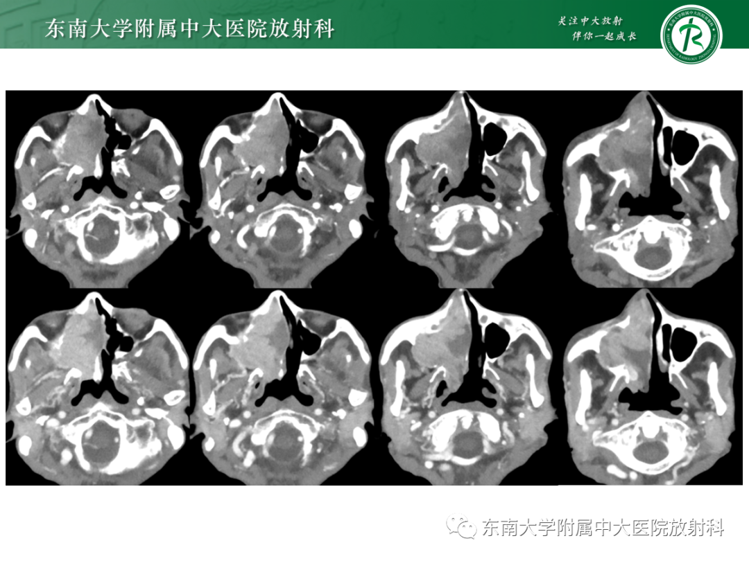 影像PPT - 【PPT】以上颌窦为中心的鼻腔鼻窦占位性病变随访-28