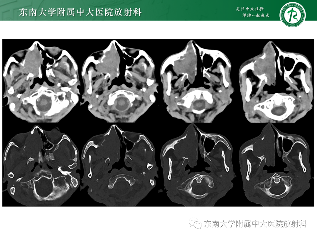 影像PPT - 【PPT】以上颌窦为中心的鼻腔鼻窦占位性病变随访-27