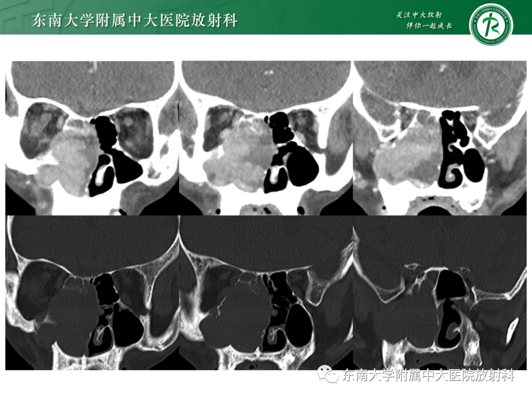 影像PPT - 【PPT】以上颌窦为中心的鼻腔鼻窦占位性病变随访-29