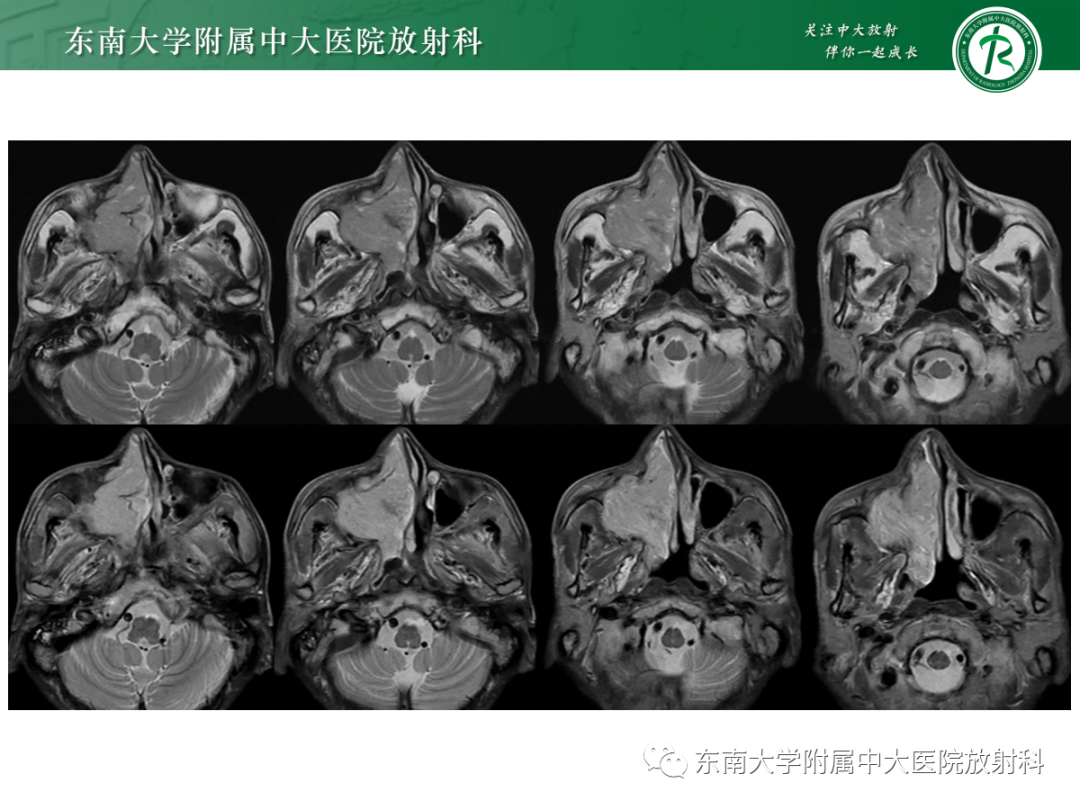 影像PPT - 【PPT】以上颌窦为中心的鼻腔鼻窦占位性病变随访-30