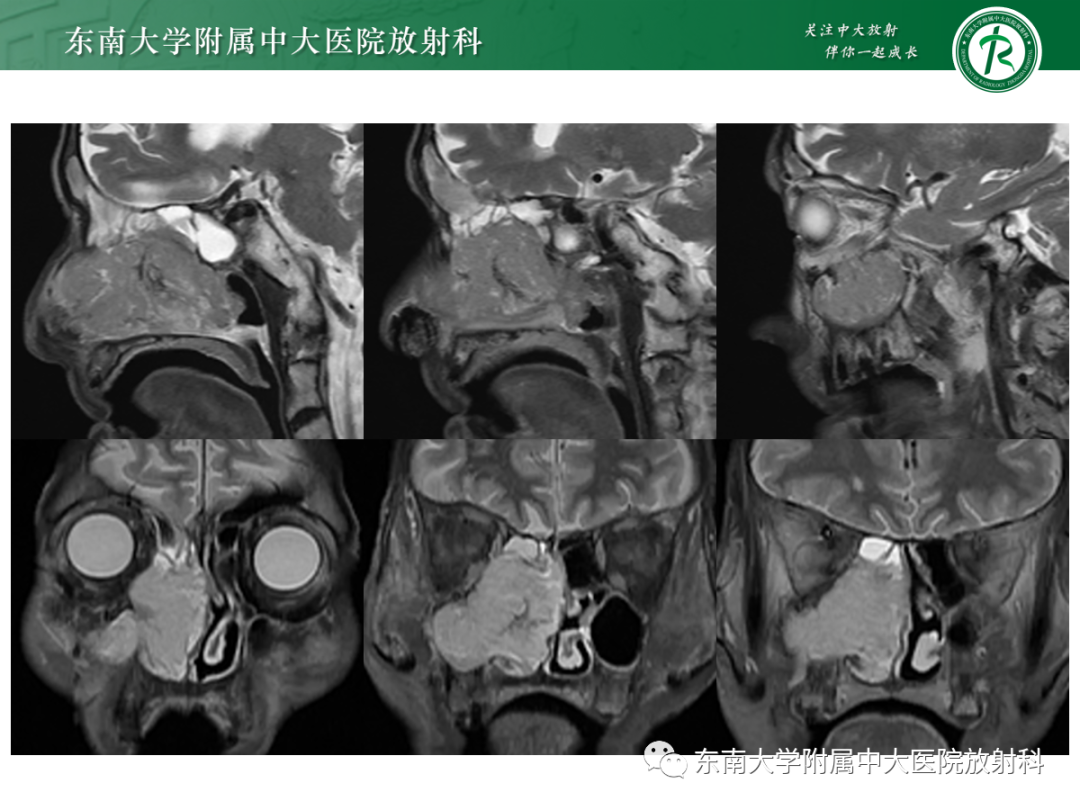 影像PPT - 【PPT】以上颌窦为中心的鼻腔鼻窦占位性病变随访-31