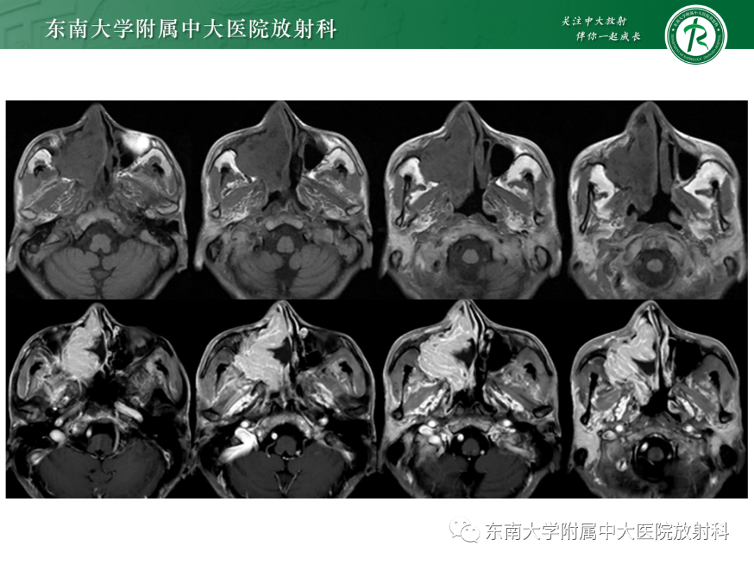 影像PPT - 【PPT】以上颌窦为中心的鼻腔鼻窦占位性病变随访-32
