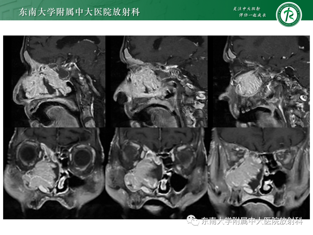 影像PPT - 【PPT】以上颌窦为中心的鼻腔鼻窦占位性病变随访-33