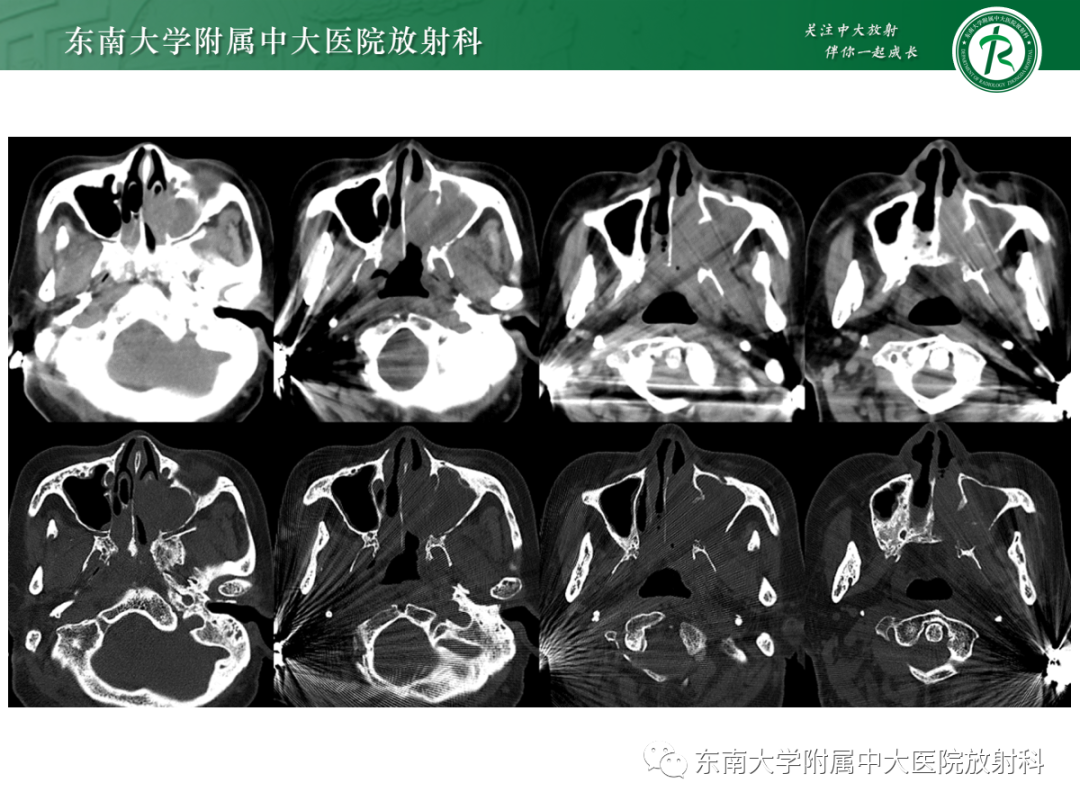 影像PPT - 【PPT】以上颌窦为中心的鼻腔鼻窦占位性病变随访-36
