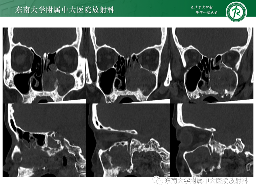 影像PPT - 【PPT】以上颌窦为中心的鼻腔鼻窦占位性病变随访-37