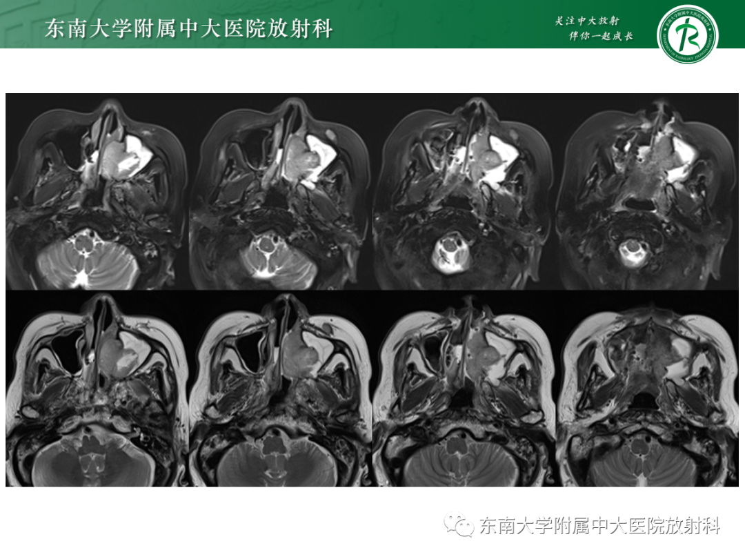 影像PPT - 【PPT】以上颌窦为中心的鼻腔鼻窦占位性病变随访-38