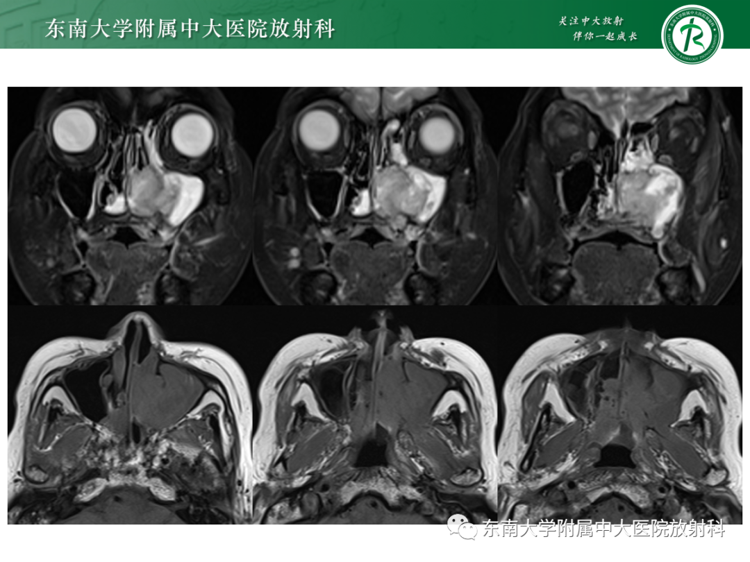 影像PPT - 【PPT】以上颌窦为中心的鼻腔鼻窦占位性病变随访-39