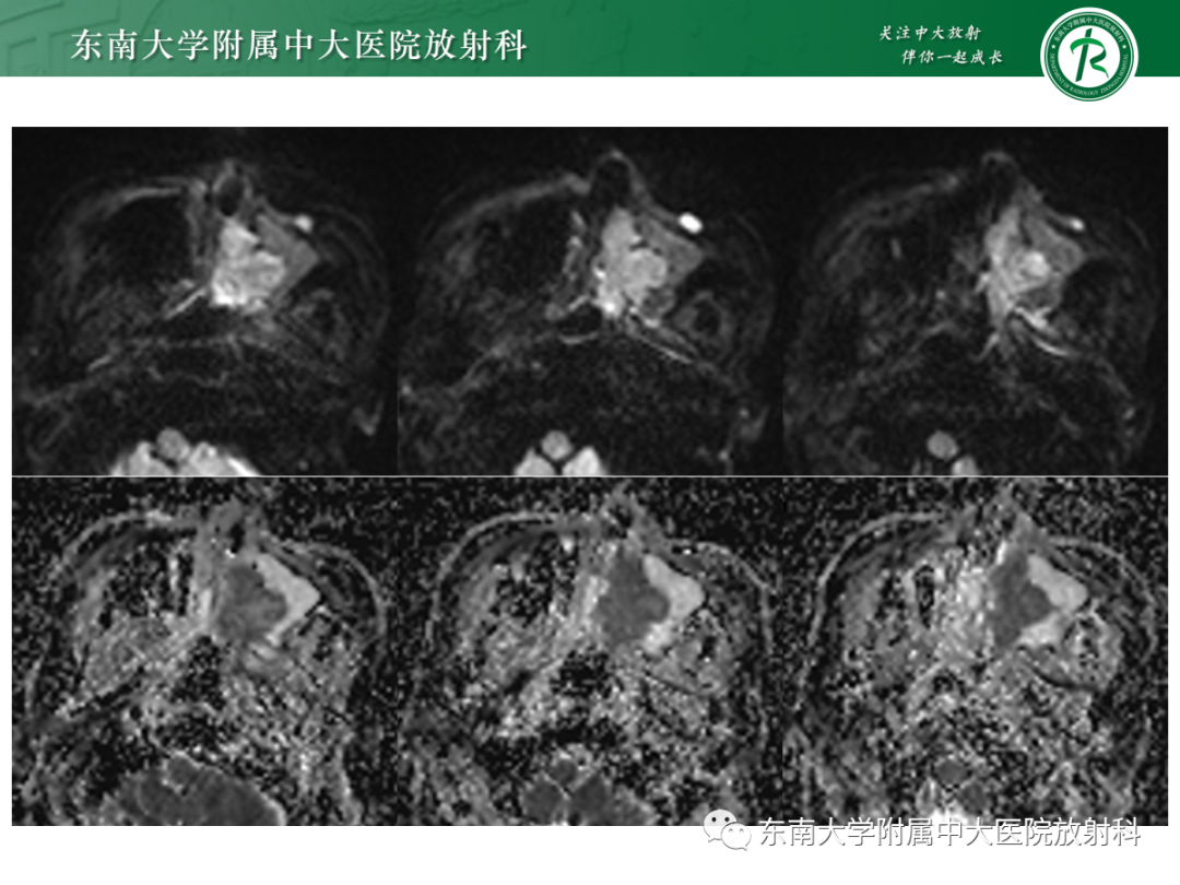 影像PPT - 【PPT】以上颌窦为中心的鼻腔鼻窦占位性病变随访-40