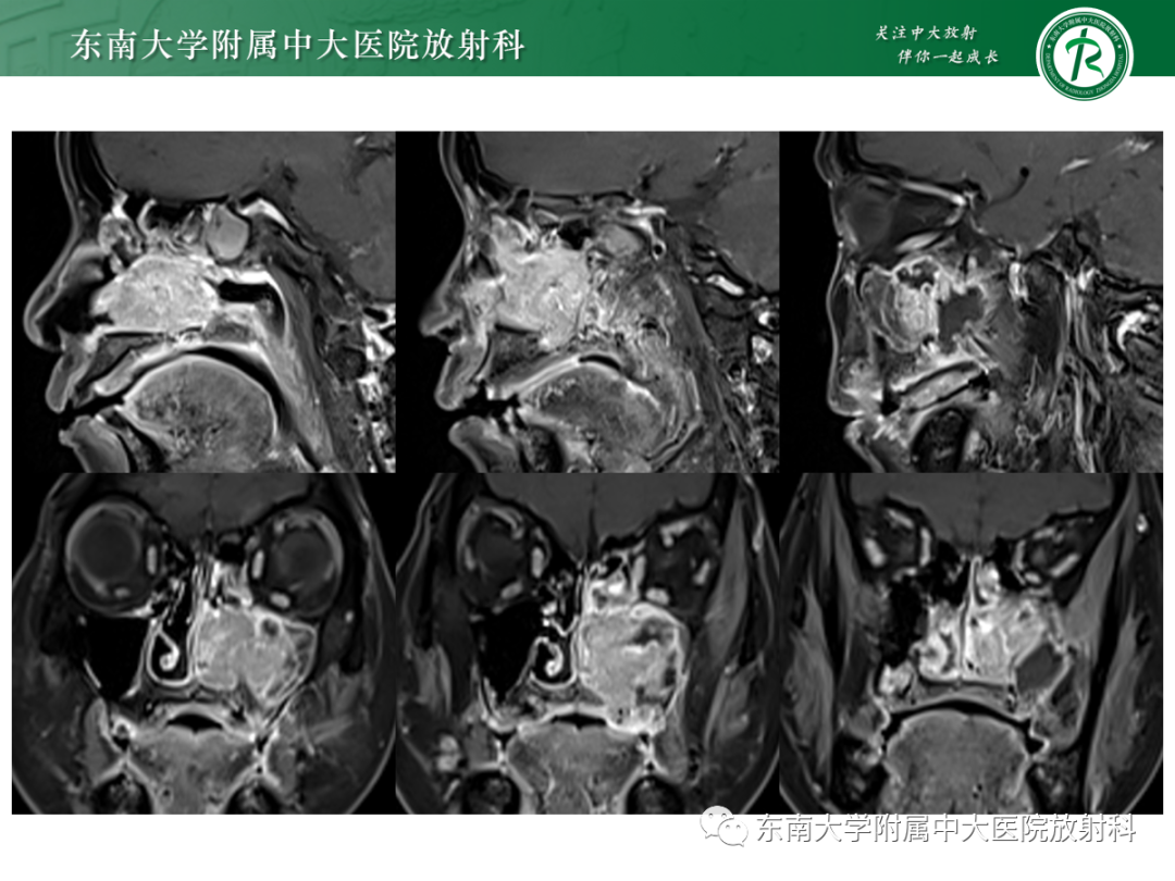 影像PPT - 【PPT】以上颌窦为中心的鼻腔鼻窦占位性病变随访-41