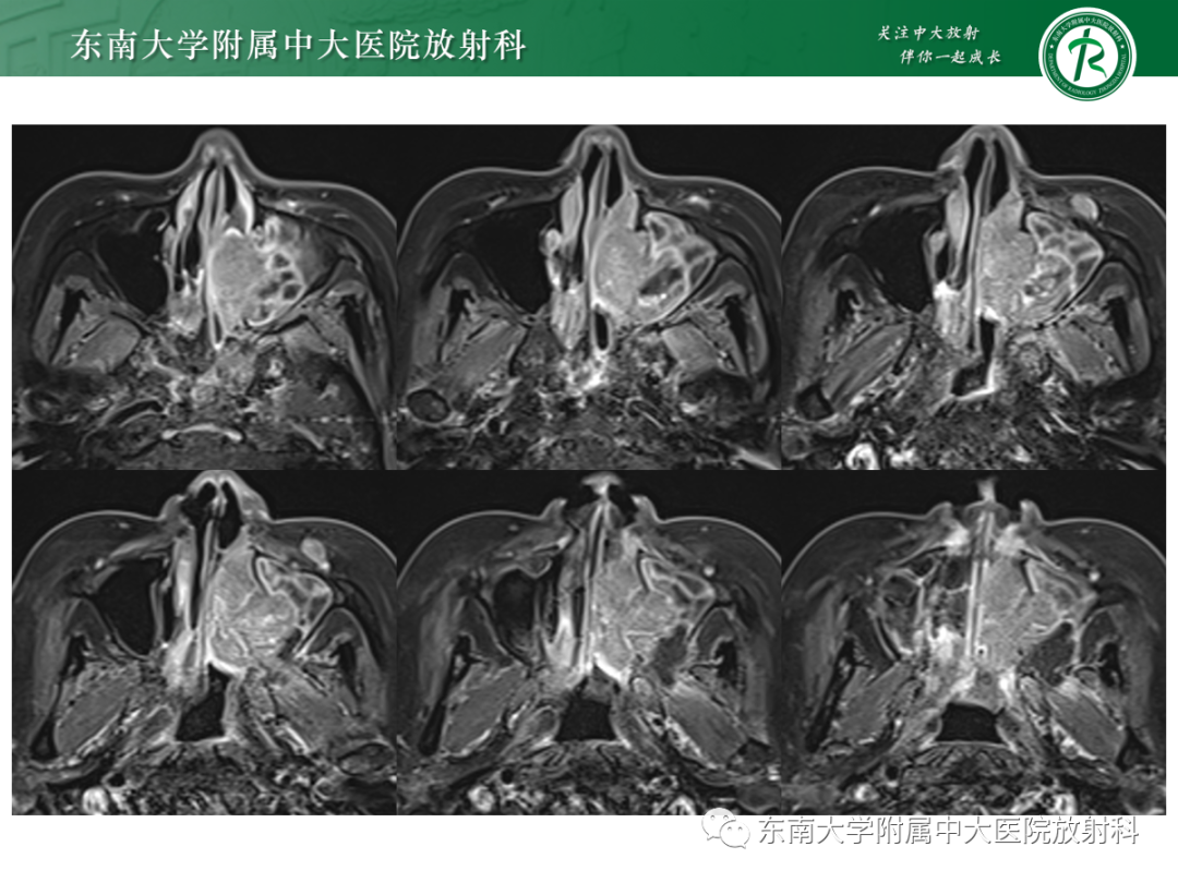 影像PPT - 【PPT】以上颌窦为中心的鼻腔鼻窦占位性病变随访-42