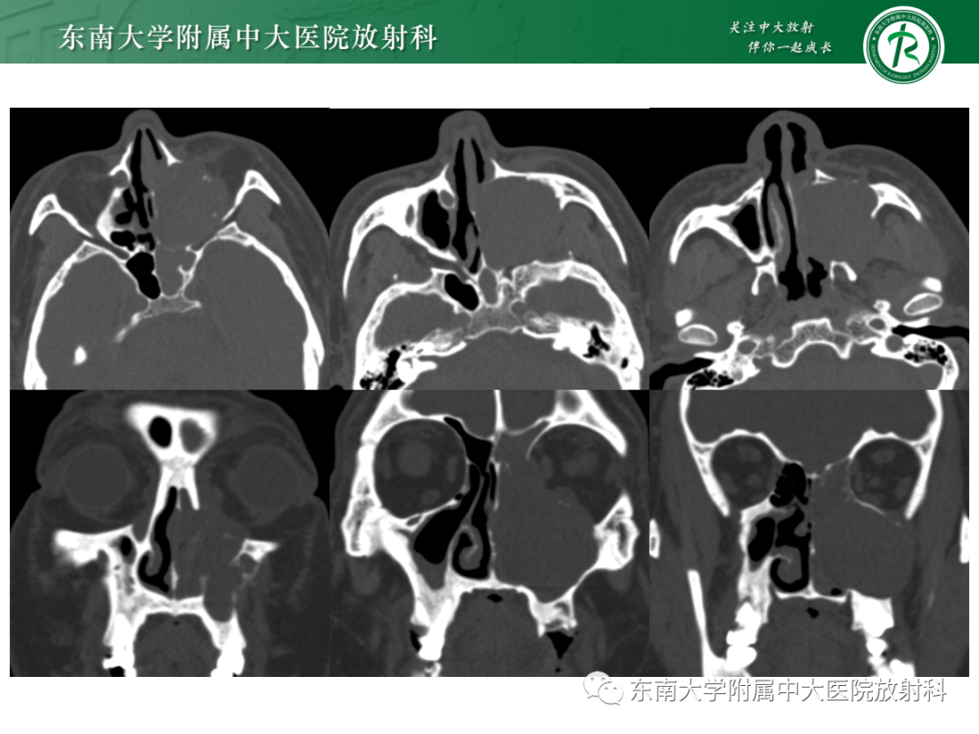 影像PPT - 【PPT】以上颌窦为中心的鼻腔鼻窦占位性病变随访-45