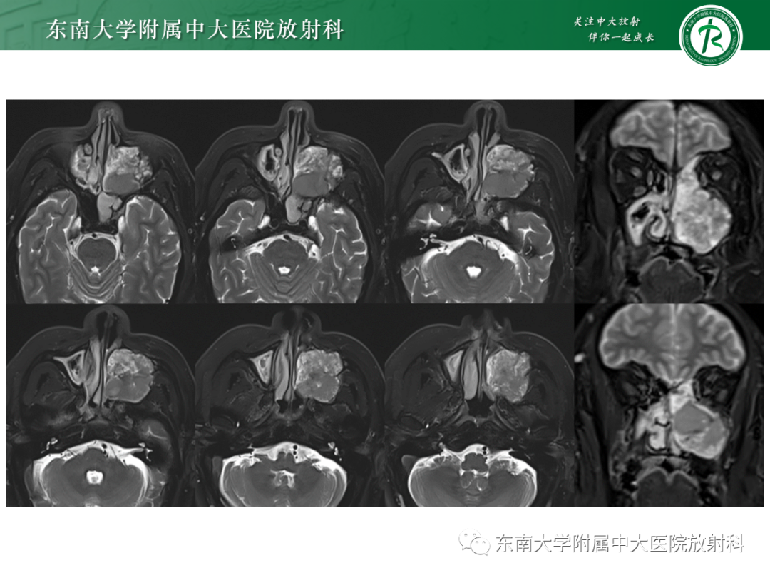 影像PPT - 【PPT】以上颌窦为中心的鼻腔鼻窦占位性病变随访-46