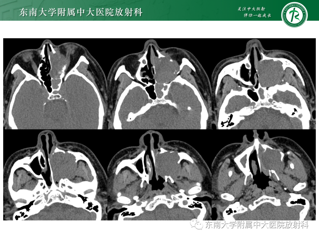 影像PPT - 【PPT】以上颌窦为中心的鼻腔鼻窦占位性病变随访-44