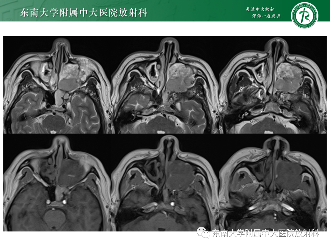 影像PPT - 【PPT】以上颌窦为中心的鼻腔鼻窦占位性病变随访-47