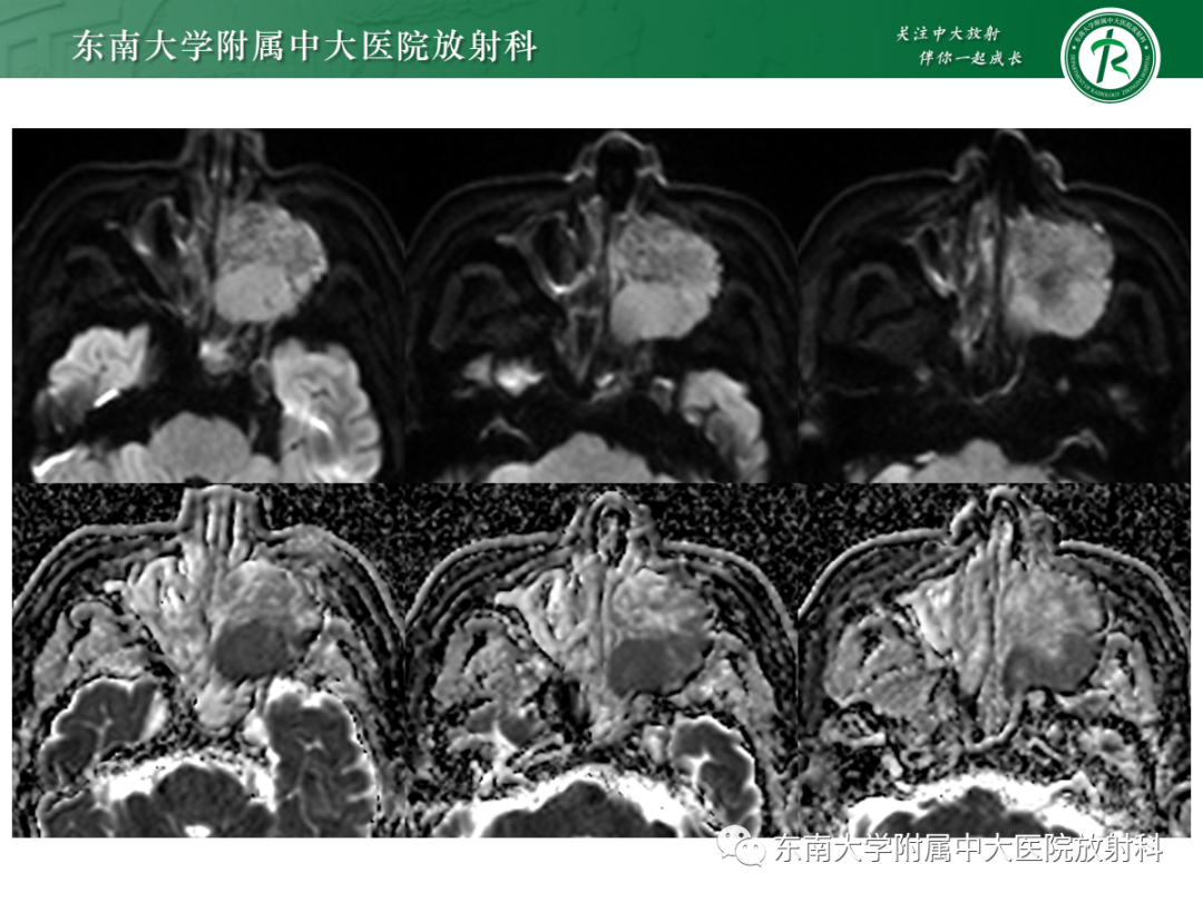 影像PPT - 【PPT】以上颌窦为中心的鼻腔鼻窦占位性病变随访-48