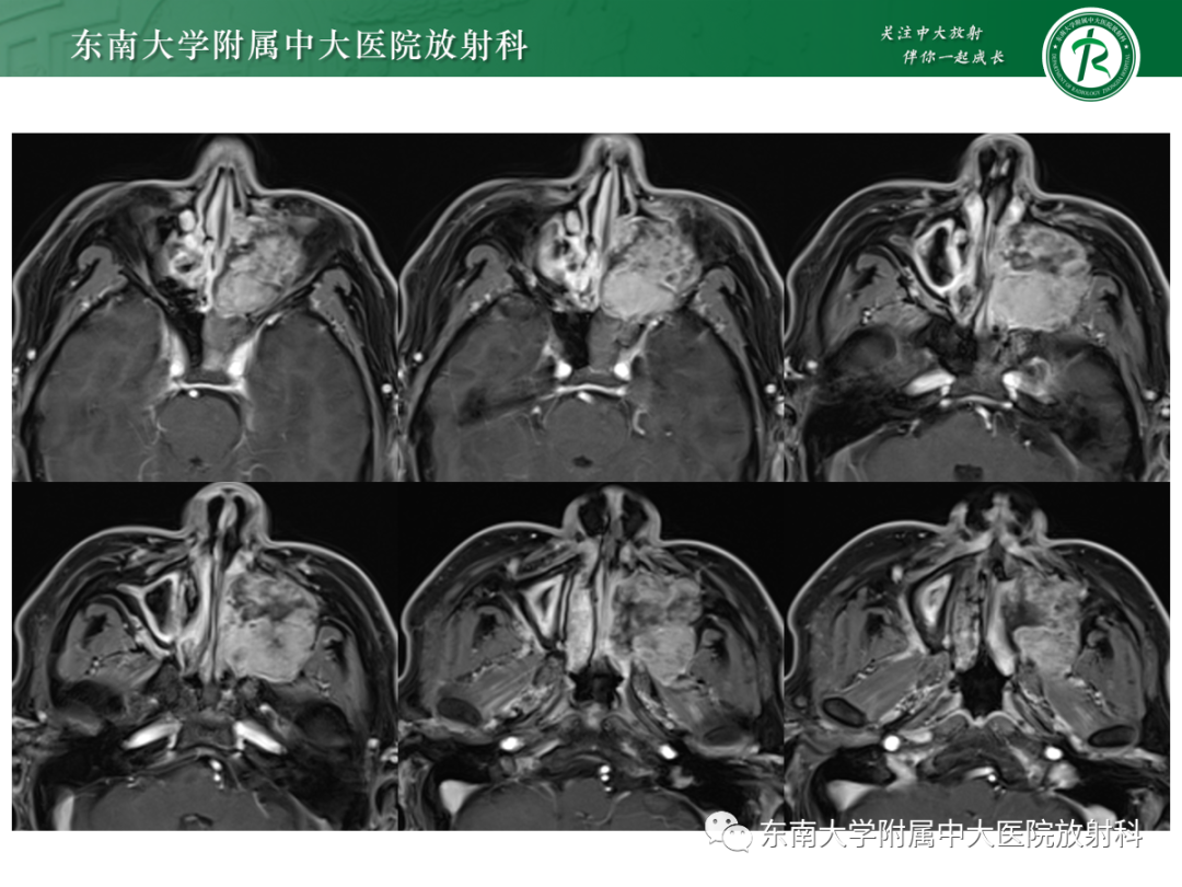 影像PPT - 【PPT】以上颌窦为中心的鼻腔鼻窦占位性病变随访-49