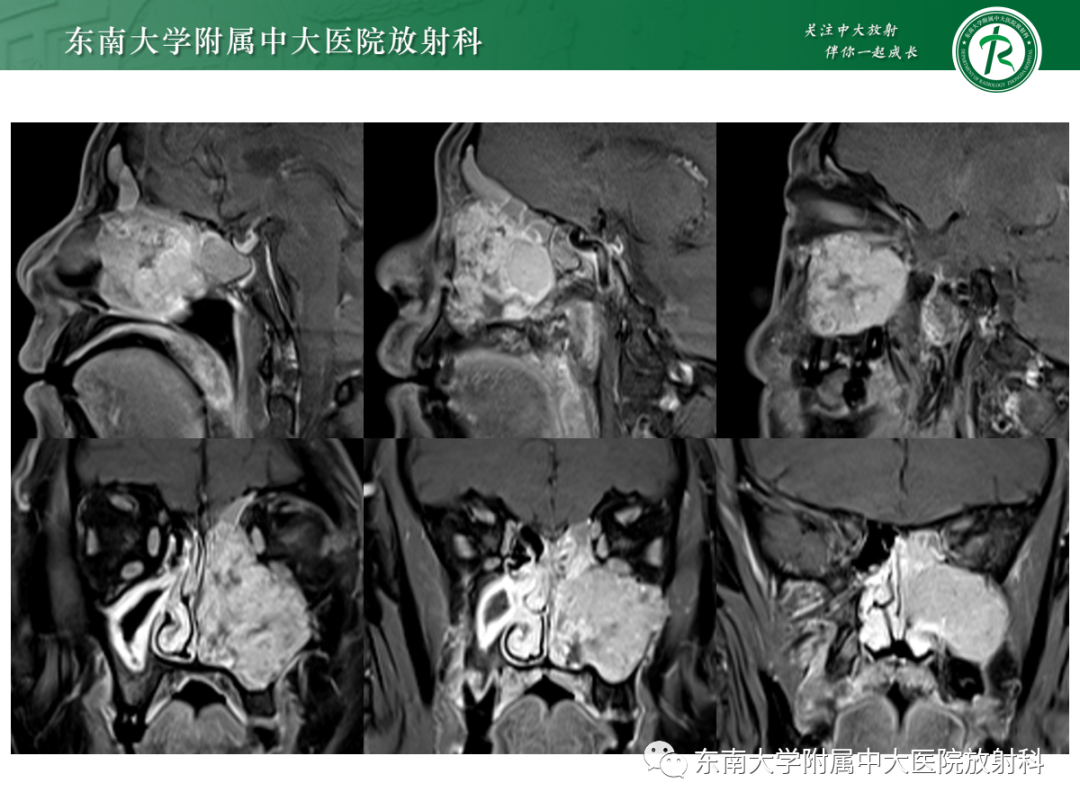 影像PPT - 【PPT】以上颌窦为中心的鼻腔鼻窦占位性病变随访-50