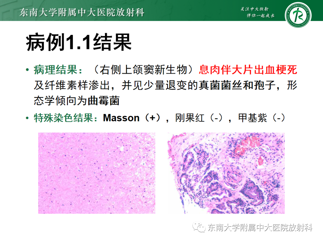 影像PPT - 【PPT】以上颌窦为中心的鼻腔鼻窦占位性病变随访-53