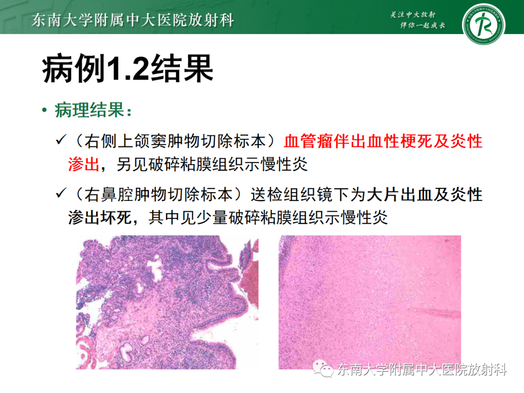 影像PPT - 【PPT】以上颌窦为中心的鼻腔鼻窦占位性病变随访-55
